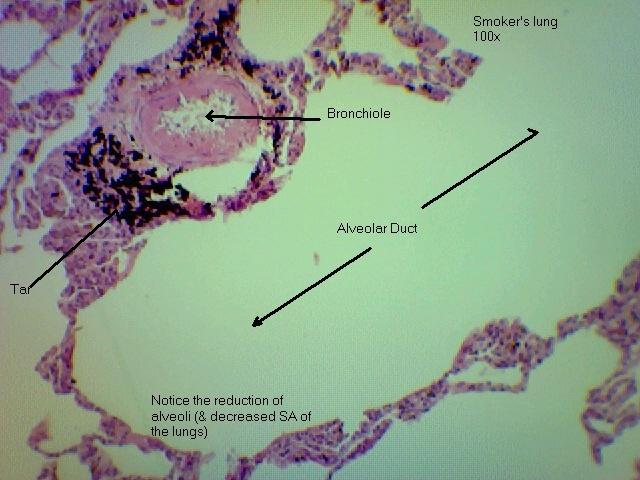 Lung, smoker's 100x 